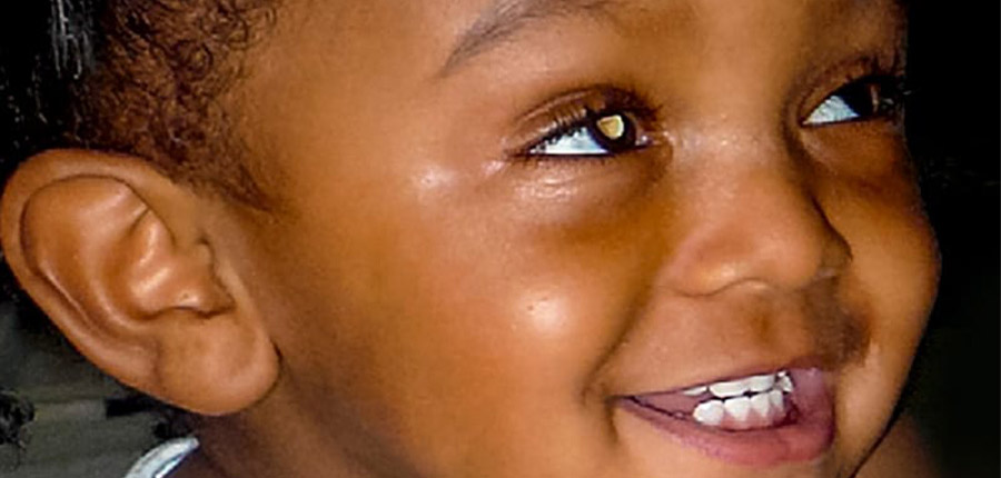 Quoi de neuf en 2024 pour le Cancer guérissable de l'œil chez l’enfant, le rétinoblastome ?