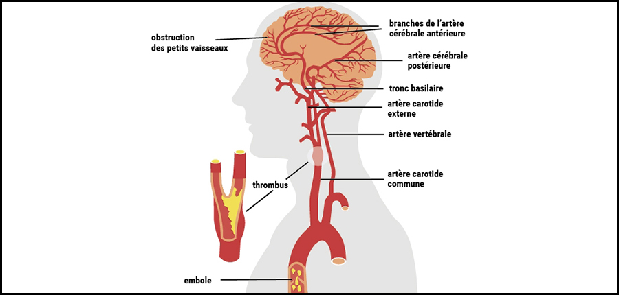 22ème Congrès National de  Cardiologie / Marrakech, 5 au 7 octobre 2017 : Révolution dans le traitement de l’Accident vasculaire cérébral