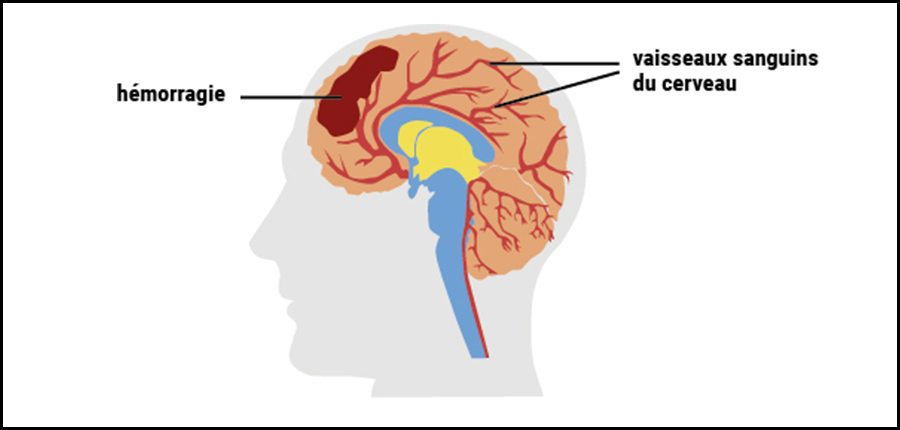 Une hypertension artérielle mal contrôlée conduit à l’accident vasculaire cérébral, à l’hémorragie cérébrale et à la crise cardiaque